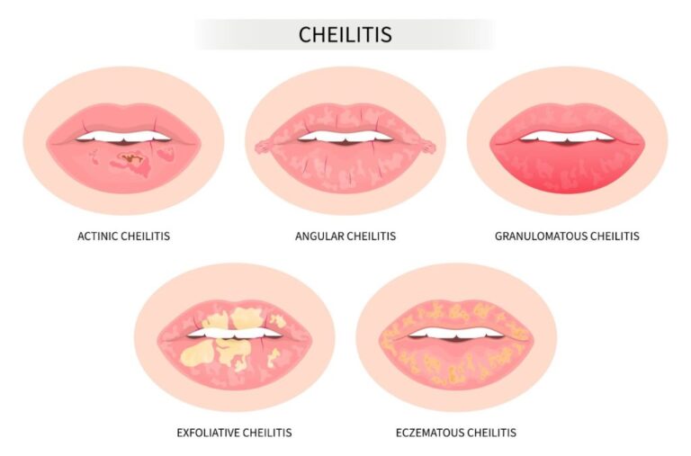 Contoh masalah bibir cheilitis