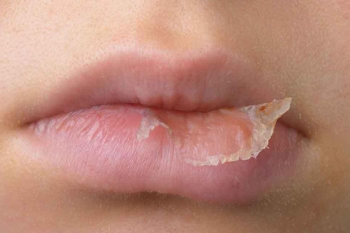 Lip Balm: 5 Tips Atasi Bibir Kering dan Kusam